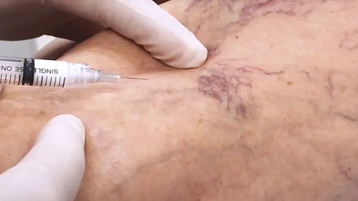 Sclerotherapy 2 - 2025-06-20T133247.832