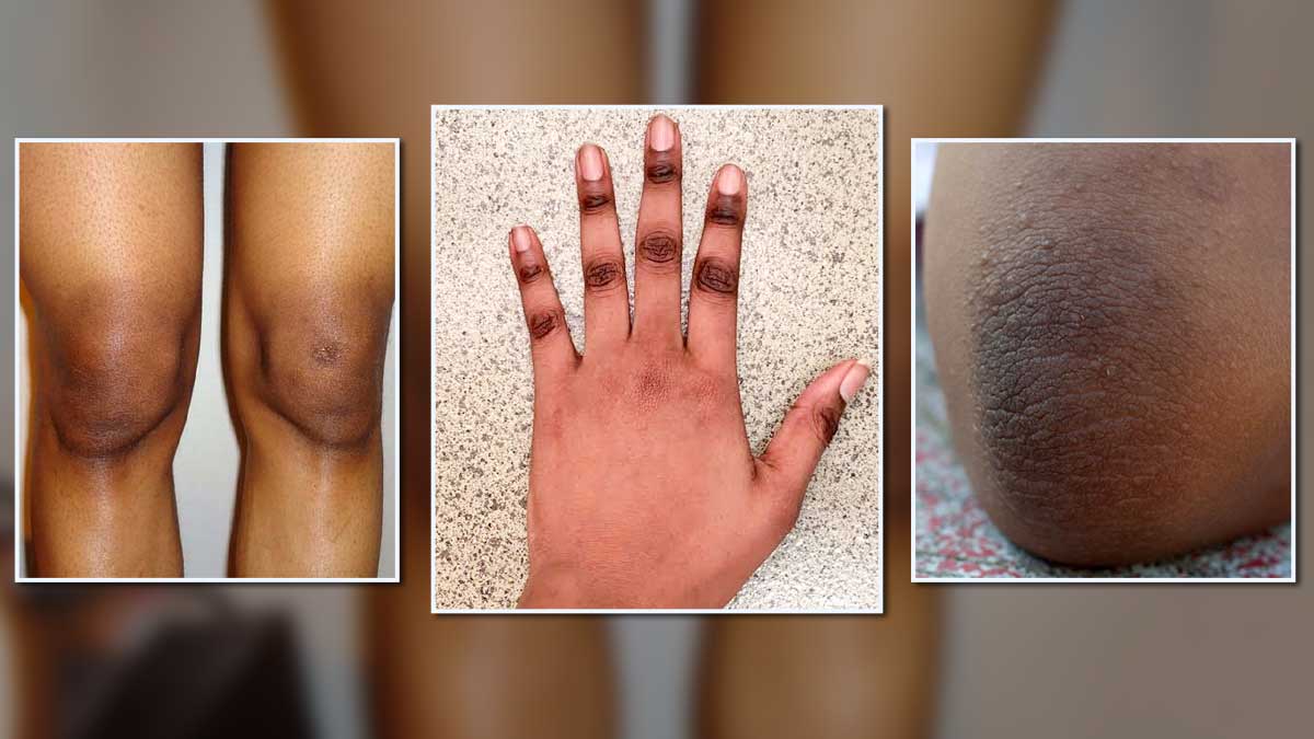 Dark Knuckles, Knees, or Elbows Making You Self-Conscious? Here’s What You Can Do