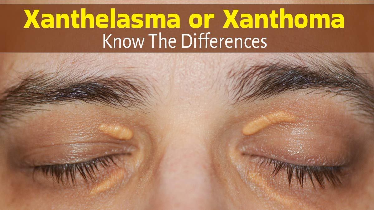Xanthelasma or Xanthoma? What Do Yellow Patches or Lumps on Skin Mean