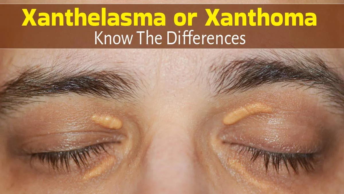 Xanthelasma or Xanthoma? What Do Yellow Patches or Lumps on Skin Mean