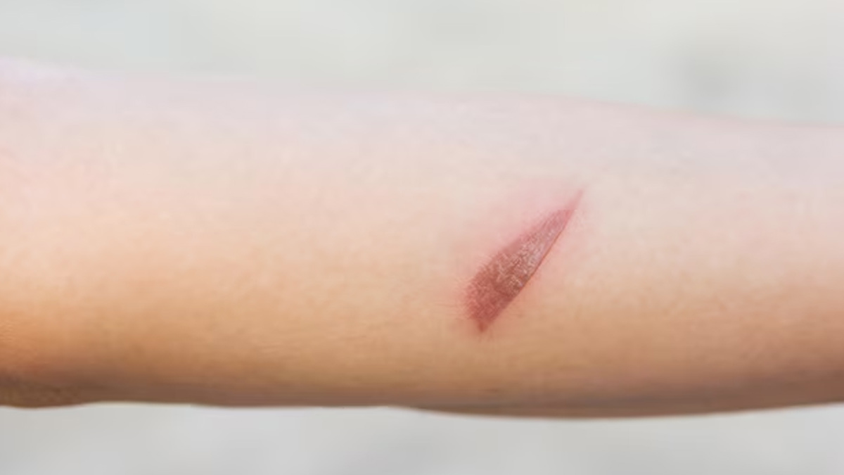 Is That A Fungal Patch Or Just Hyperpigmentation? Simple Ways To Manage Both