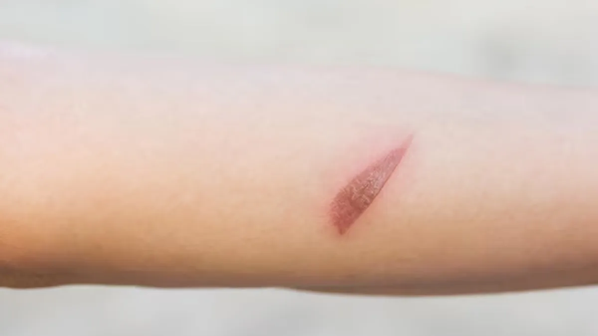 Is That A Fungal Patch Or Just Hyperpigmentation? Simple Ways To Manage Both