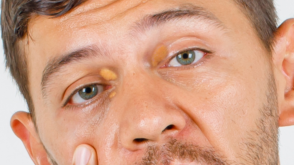 Xanthelasma 3 - 2025-06-24T112823.969