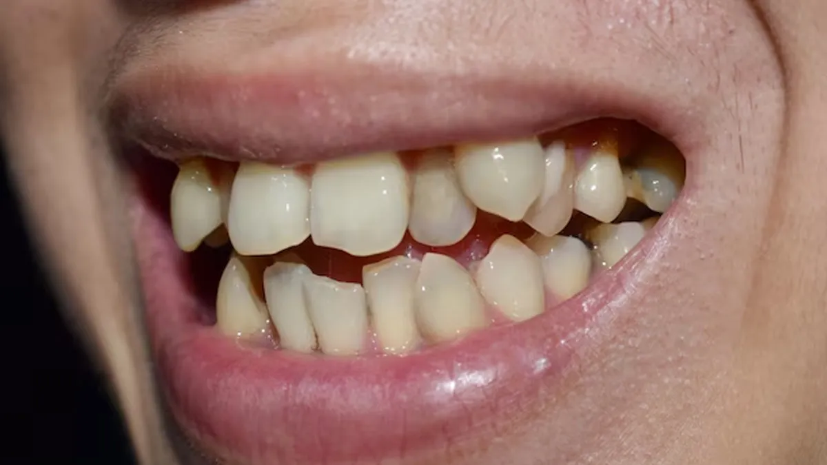 9 Common Causes Of Crooked Teeth And Effective Straightening Options