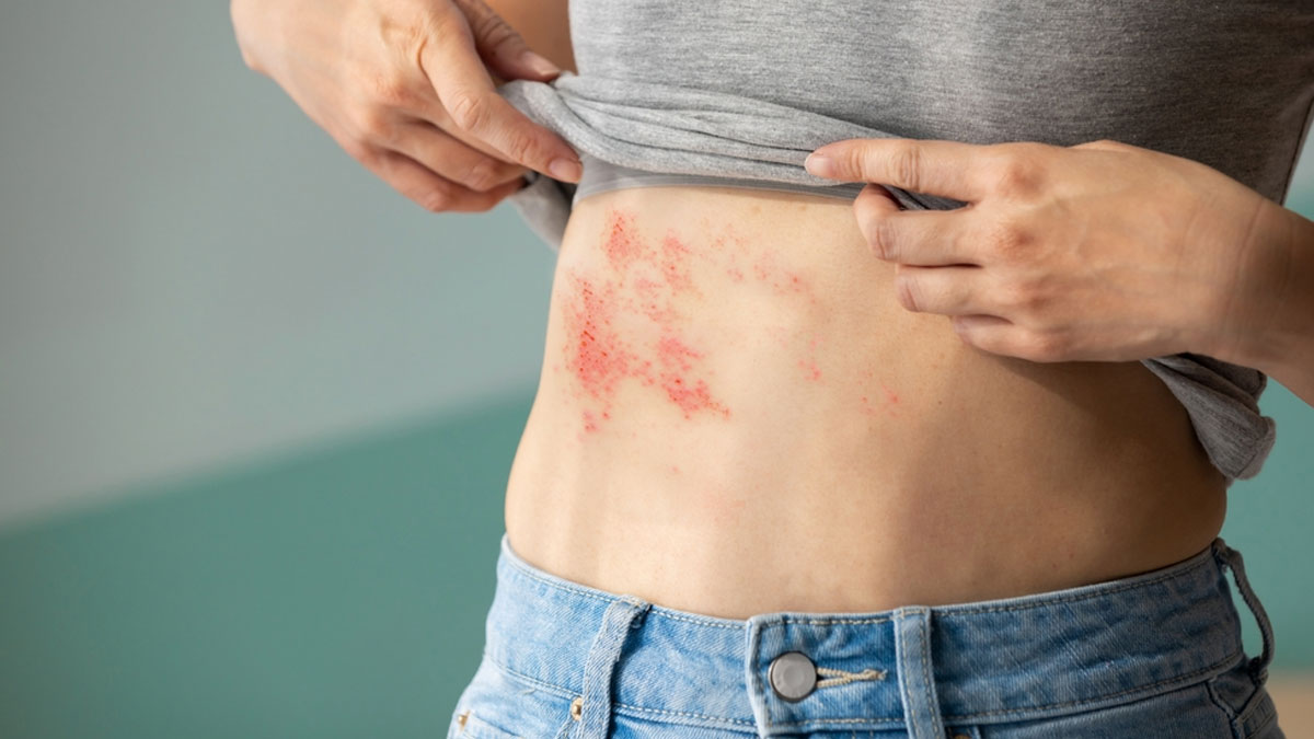 The Hidden Heart Risk Of Shingles: How A Common Virus Can Impact Your Cardiovascular Health