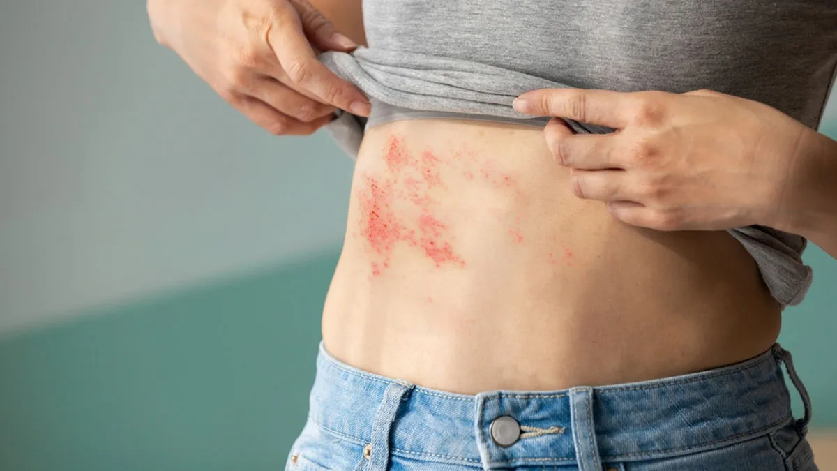 The Hidden Heart Risk Of Shingles: How A Common Virus Can Impact Your Cardiovascular Health