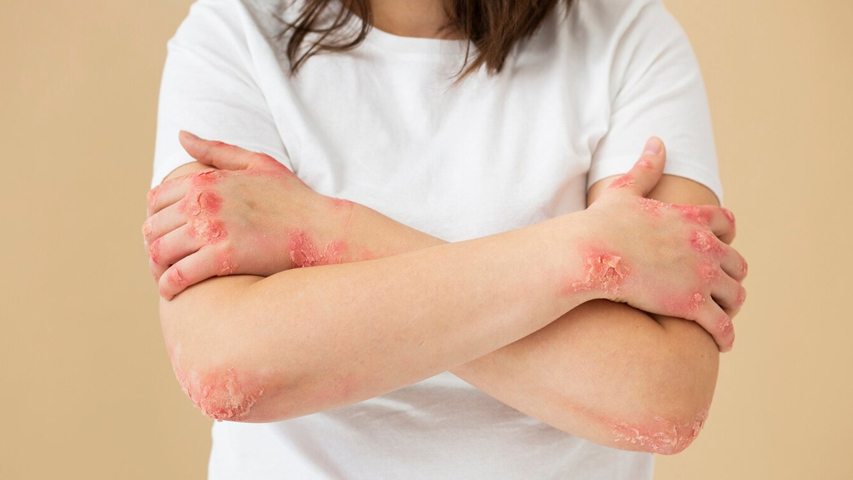 Psoriasis patches on skin