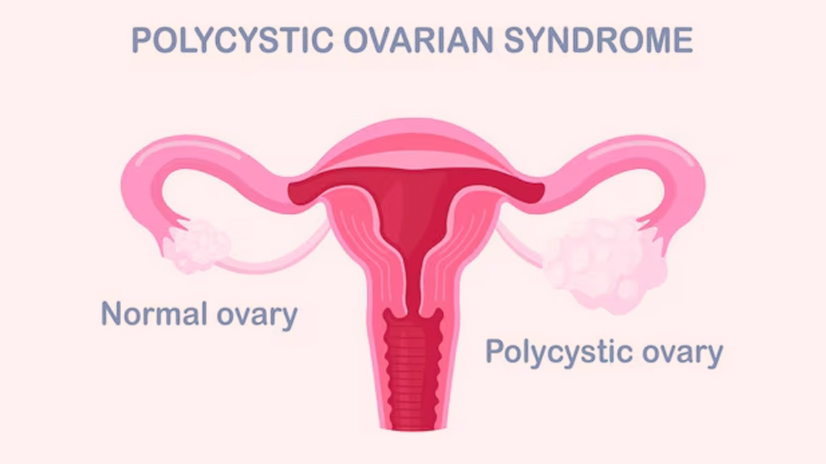 PCOS