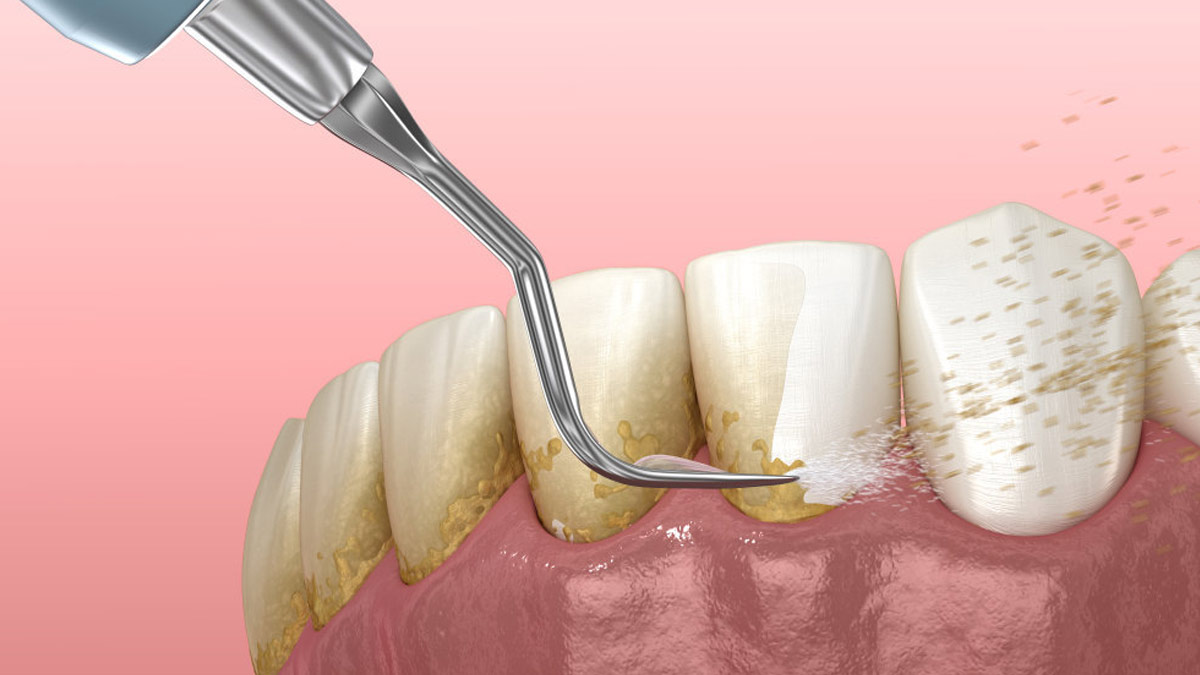 Does Tooth Scaling Damage Your Teeth? Debunking Common Myths and Facts