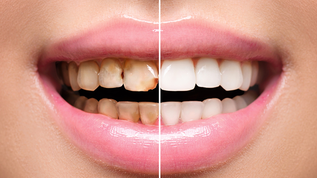 tooth scaling 1 - 2025-06-26T150238.696