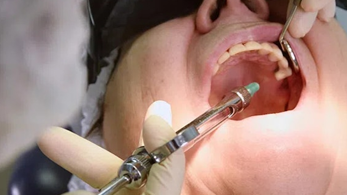 tooth scaling damages teeth 2 - 2025-06-26T150235.755