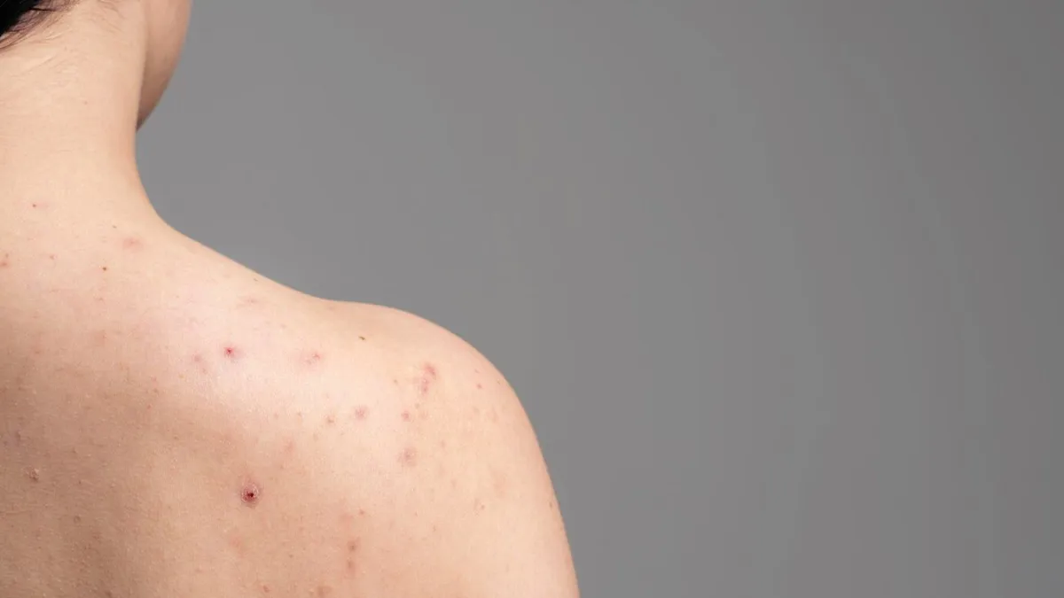 Is Your Perfume Giving You Body Acne? Here Are Fragrance And Skin Interactions You Should Know