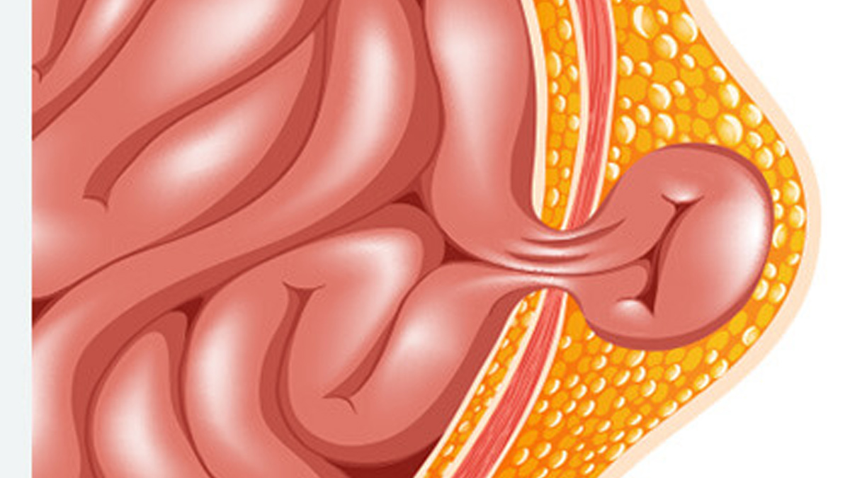 suryakumar yadav sports hernia 3 - 2025-06-27T132500.289