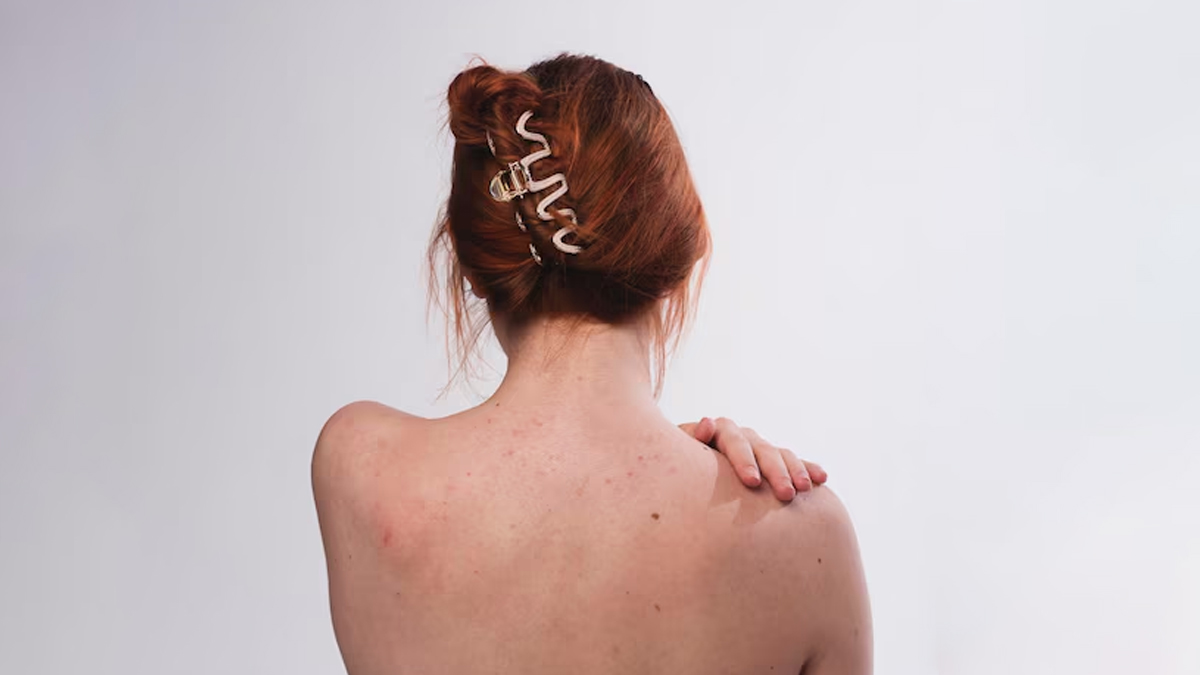 body-acne