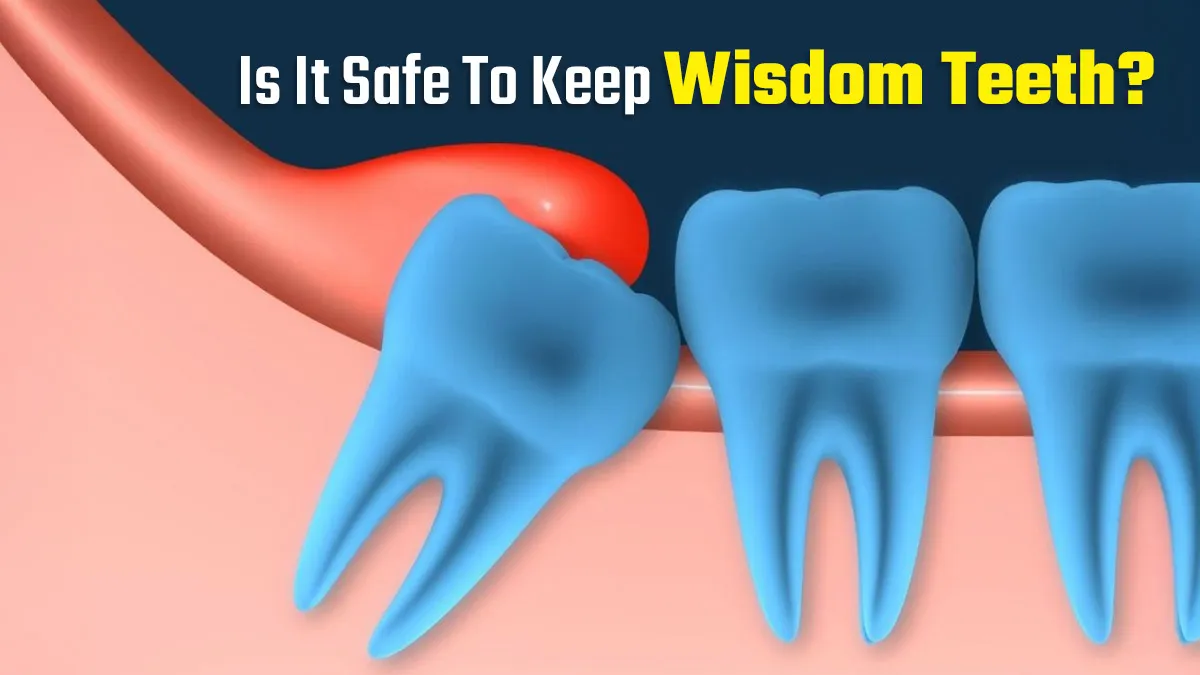 Is It Safe to Keep Wisdom Teeth? Know From A Dentist
