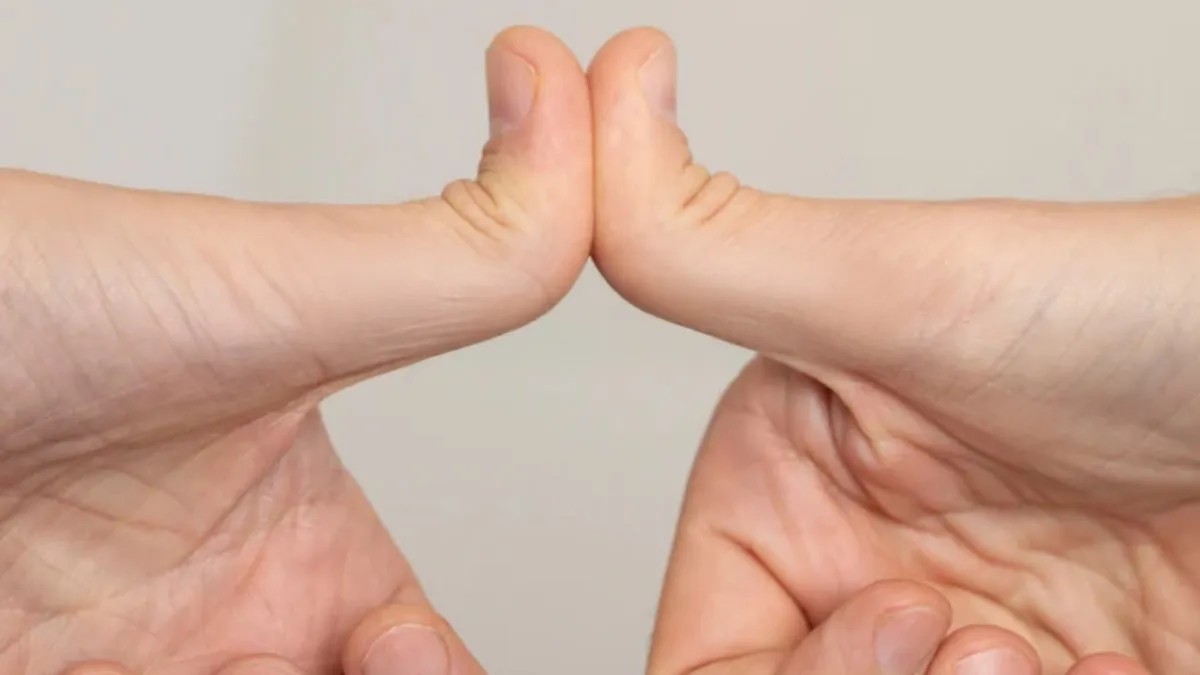 Joint Hyperlaxity In Women: When Flexibility Becomes A Disability