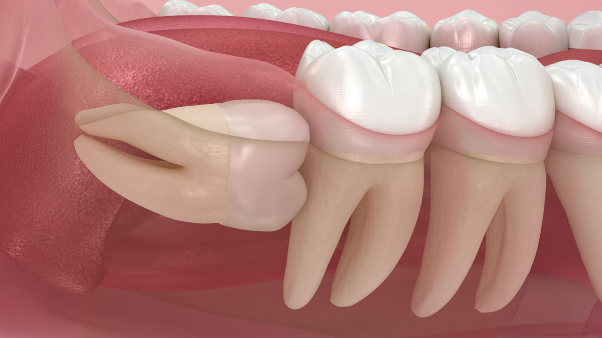 is wisdom teeth safe 2 - 2025-06-30T130827.660