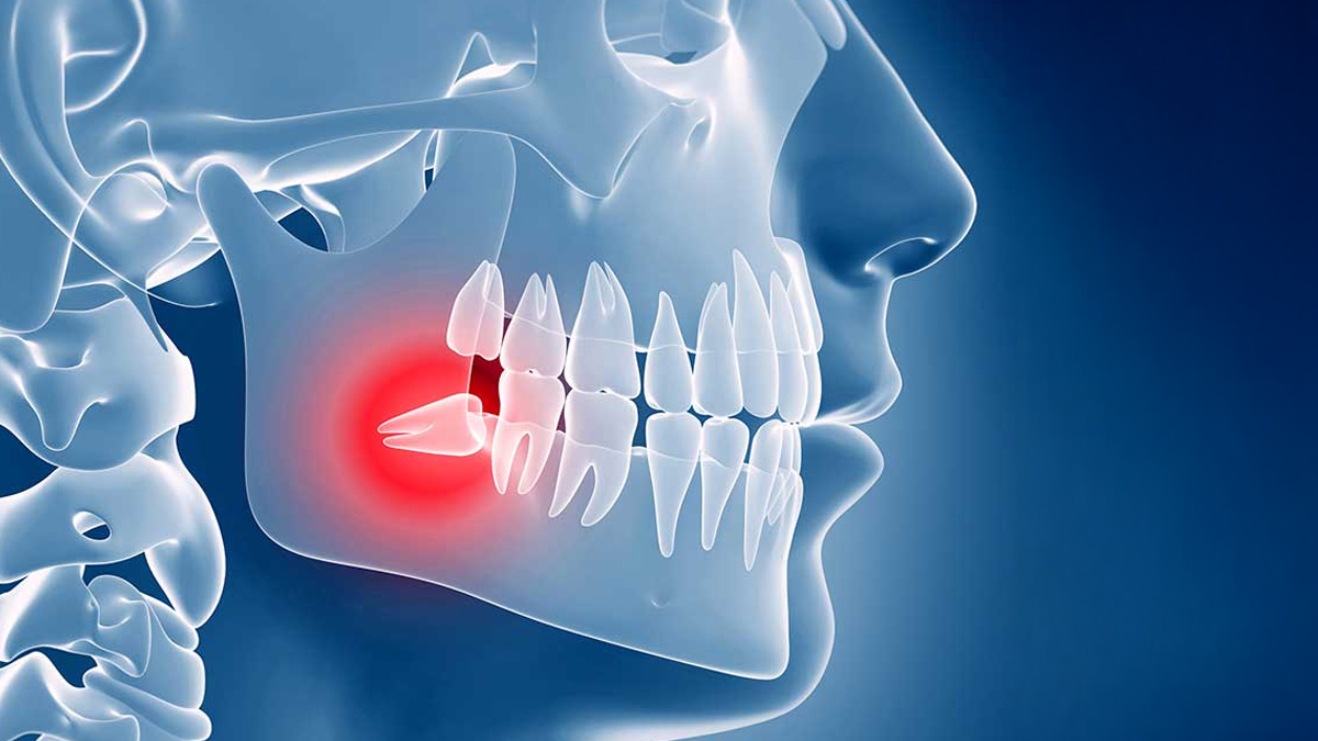 Wisdom Teeth 3 - 2025-06-30T130823.623