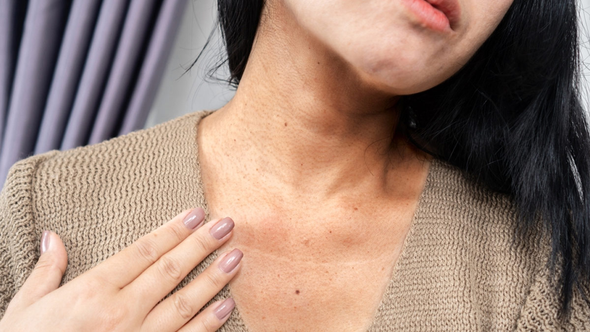 Acanthosis-Nigricans