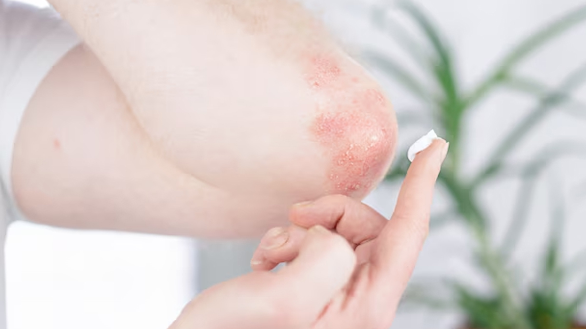 fungal-infection