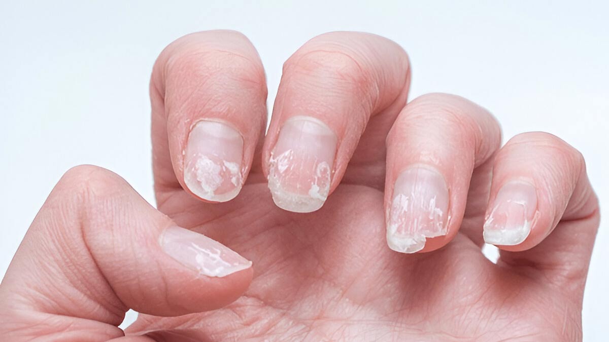 Why Your Fingernails Peel More In Humid Weather And How To Strengthen Them