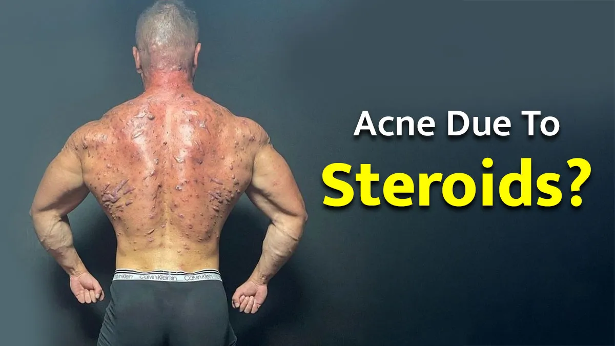 Can Taking Steroids Give You Acne? Causes, Symptoms, Treatment and Prevention