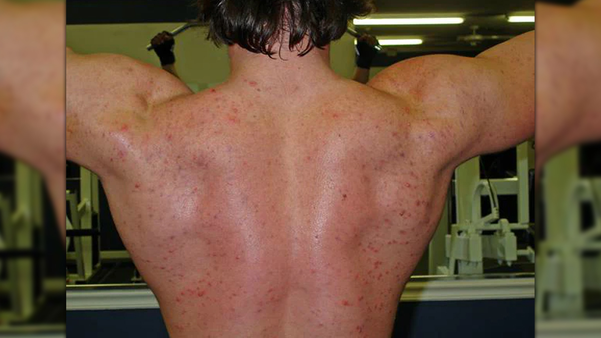 acne from steroids 1 - 2025-07-01T153512.826