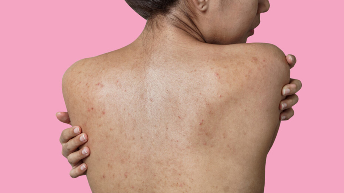 steroids causing acne 3 - 2025-07-01T153521.147