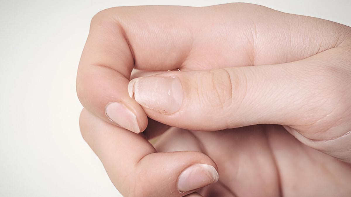 fingernail-peeling