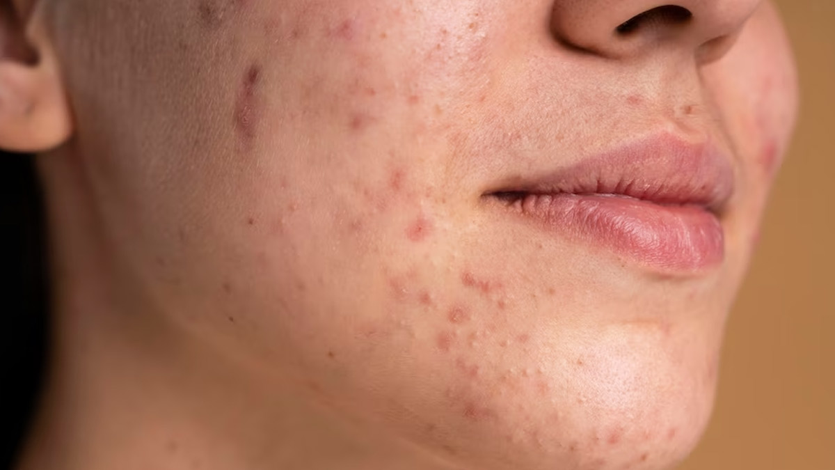 Best Dermat-Approved DIY Moisturiser For Acne Prone Skin