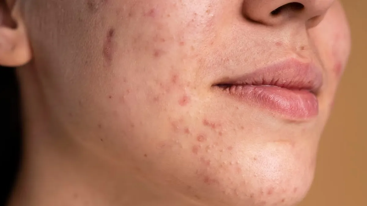 Best Dermat-Approved DIY Moisturiser For Acne Prone Skin