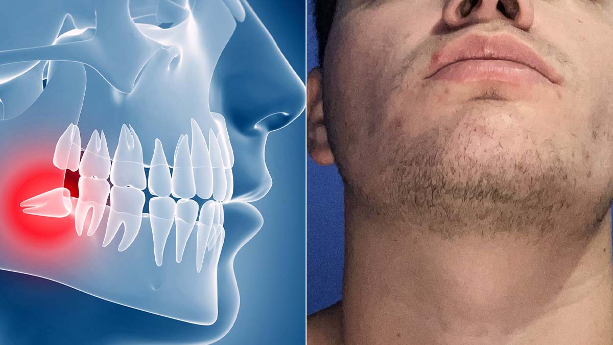 Do Wisdom Teeth Actually Make Your Jaw Bigger? Dentist Separates Fact from Myth