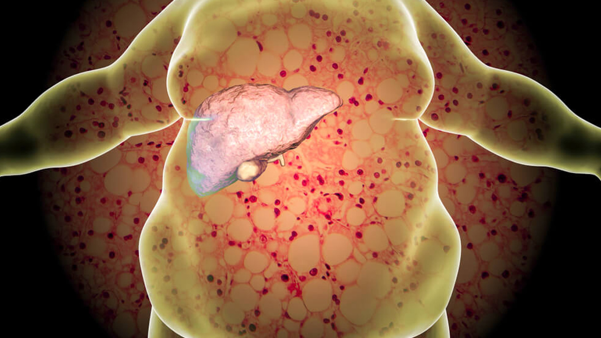 fatty liver by boba tea 1 - 2025-07-03T151850.621