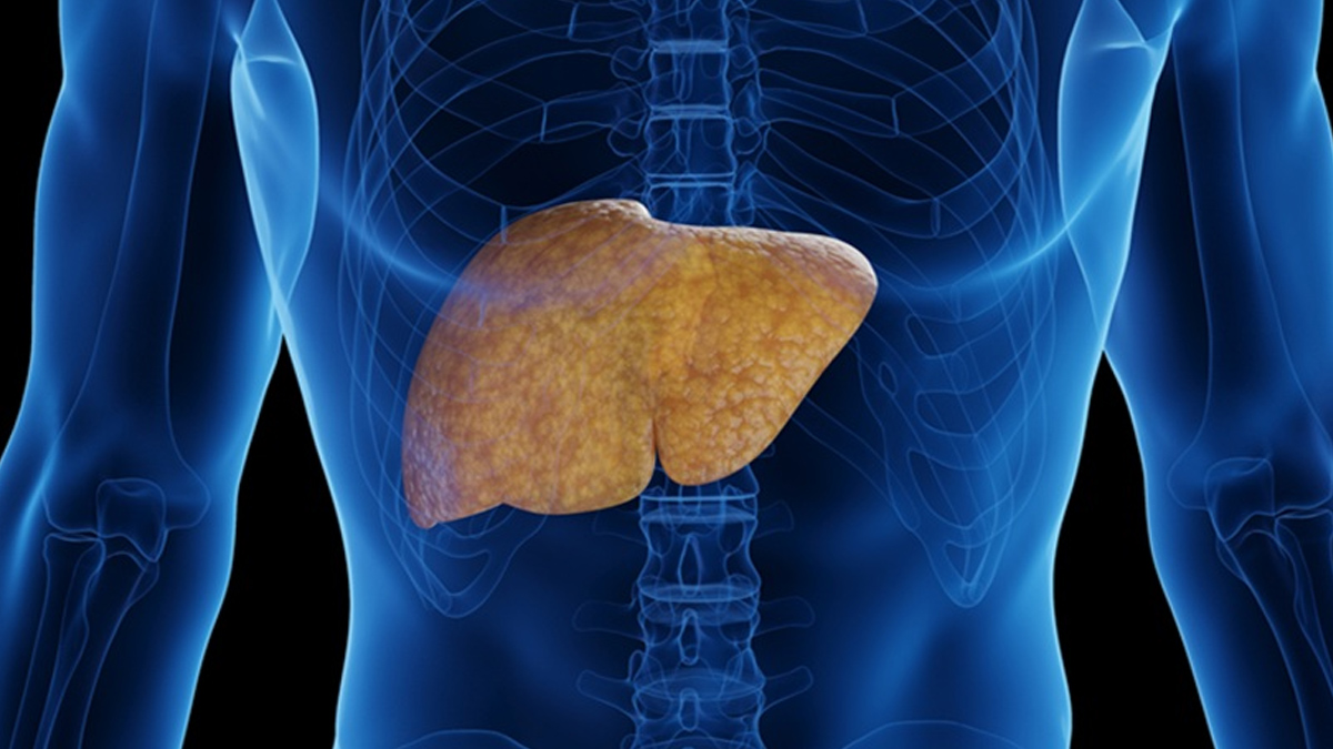 MASLD 3 - 2025-07-03T151852.284