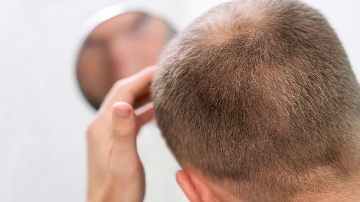 Alopecia Areata Causing Your Hair Loss: Avoid These 5 Things That Worsen Condition