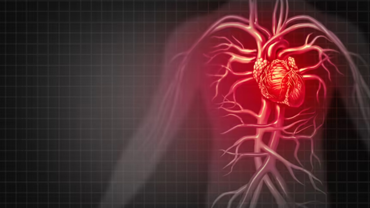 What Is the Main Cause of Myocardial Infarction? Doctor Explains