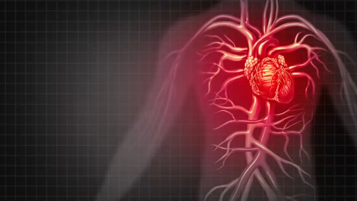 What Is the Main Cause of Myocardial Infarction? Doctor Explains
