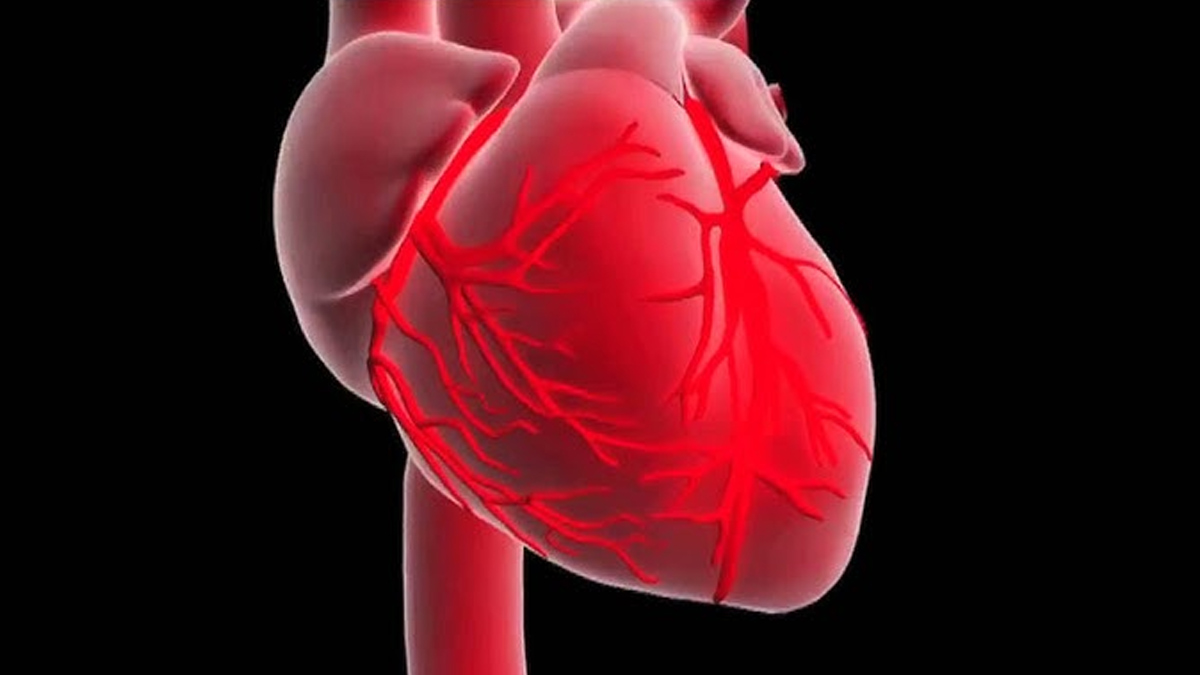 cause of Myocardial Infarction 2 - 2025-07-07T154004.709