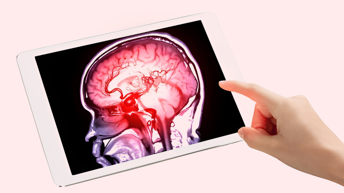 brain-stroke