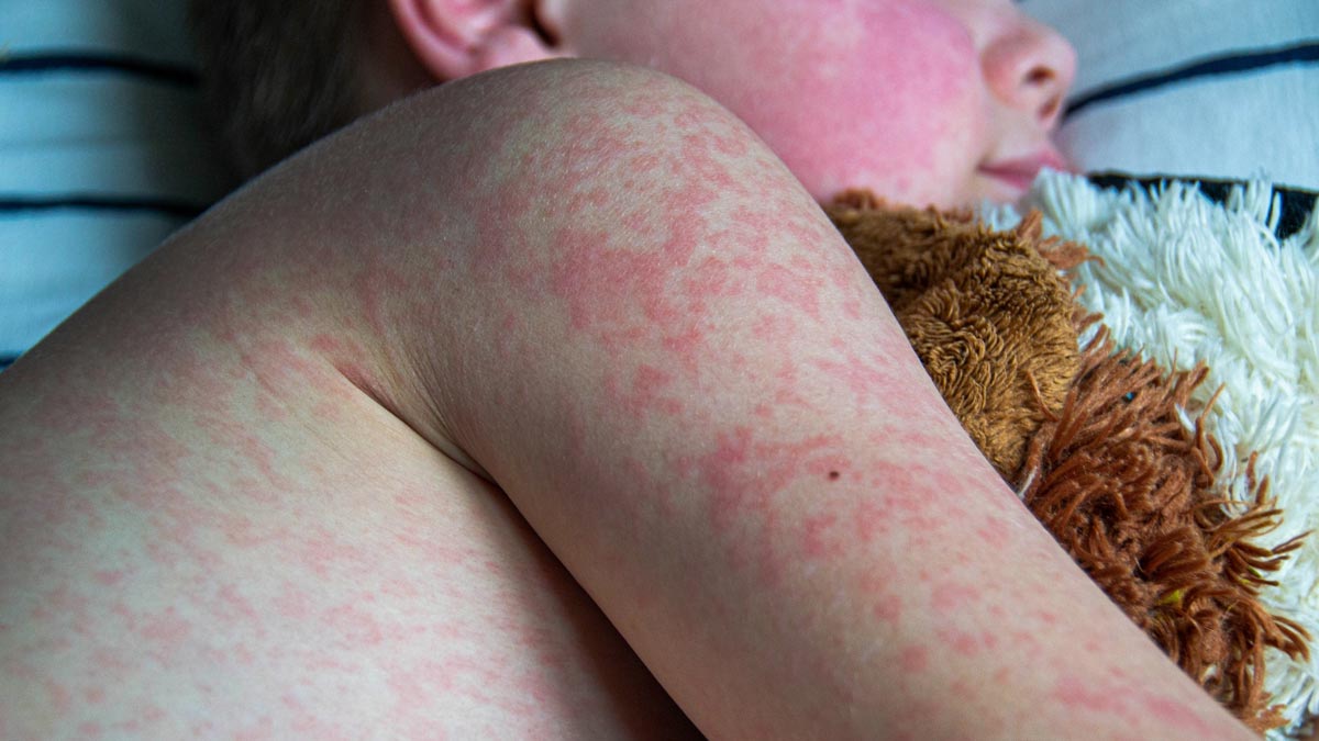 US Reports Highest Measles Case Tally In 33 years; Know More About The Deadly Disease