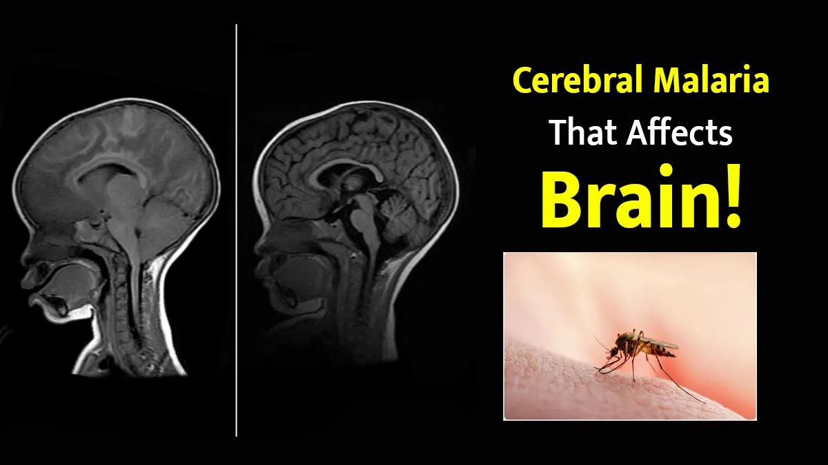 What is Cerebral Malaria? How Malaria Affects the Brain and What You Need to Know