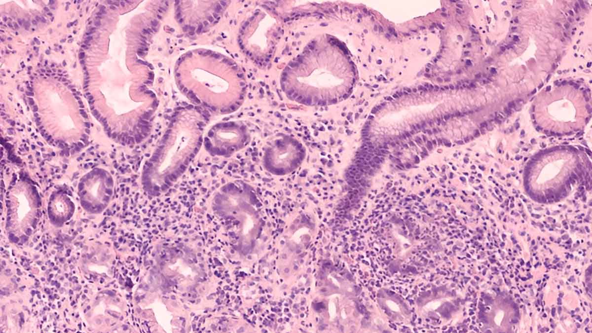 Study Links 76% Of Future Stomach Cancer Cases To H. Pylori: Know Treatment Options and Prevention Tips