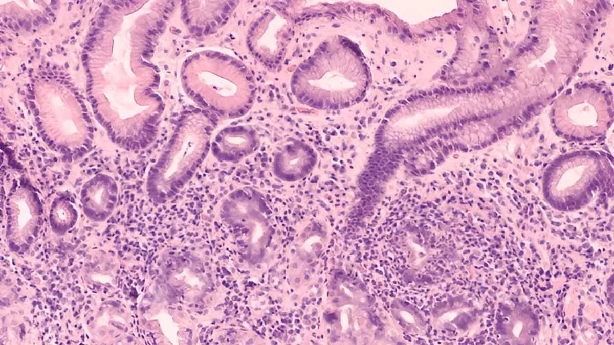 Study Links 76% Of Future Stomach Cancer Cases To H. Pylori: Know Treatment Options and Prevention Tips