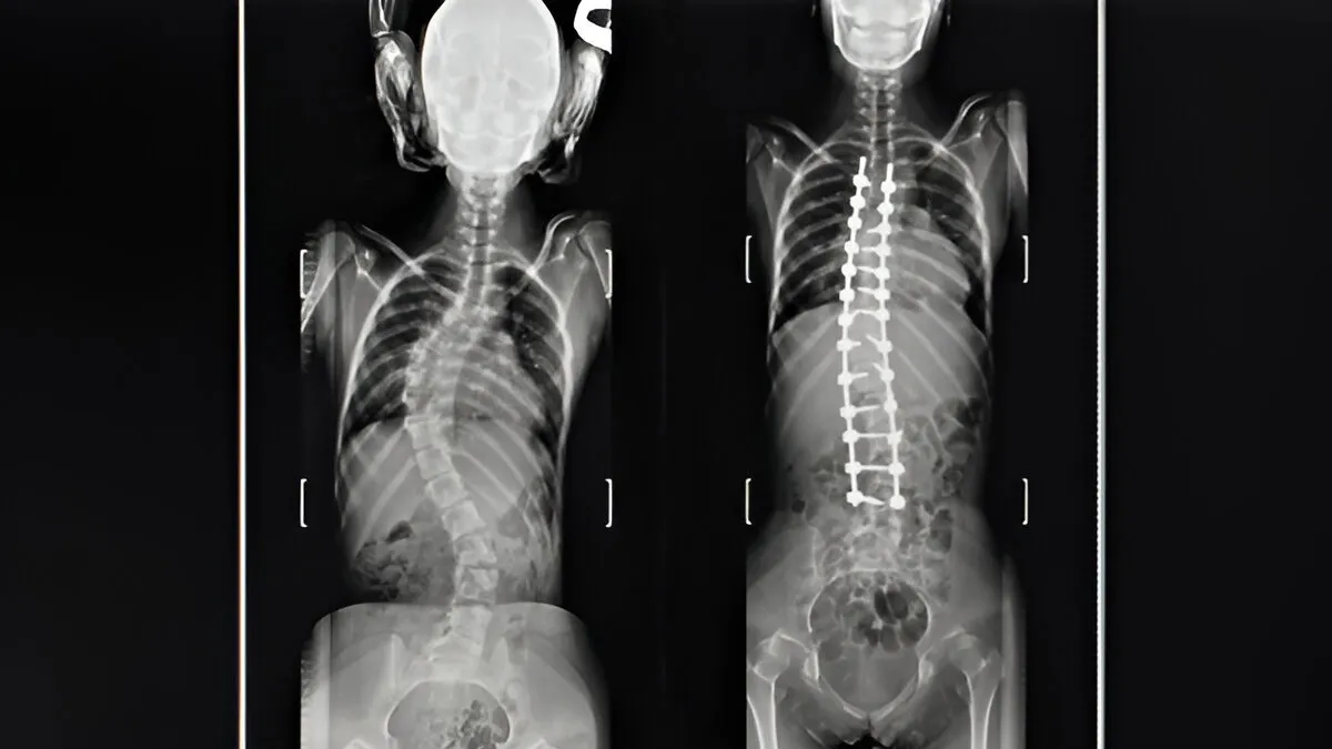 What Is Adolescent Idiopathic Scoliosis That Affects Children Aged Between 10 And 18?