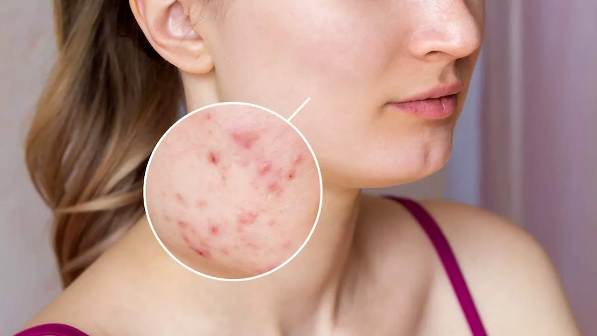 Can Your Skin Be Better One Week After You Quit Smoking? Expert Shares The Good News