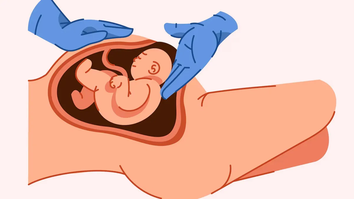 Do Planned C-Sections Increase Your Child's Risk Of Serious Conditions?