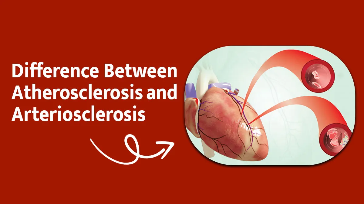 Atherosclerosis vs Arteriosclerosis: Which One Should You Worry About?