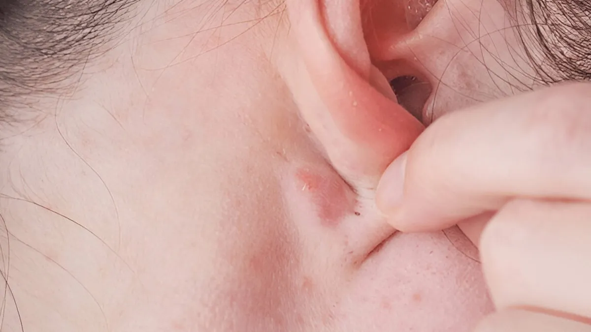 Why You Might Be Getting Recurring Pimples Behind Ears, Jawline Or Back