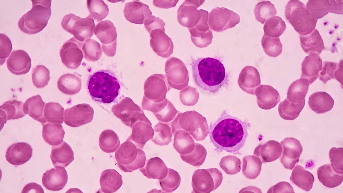 The Quiet Emergency: Why Rare Cancers In India Deserve Urgent Attention