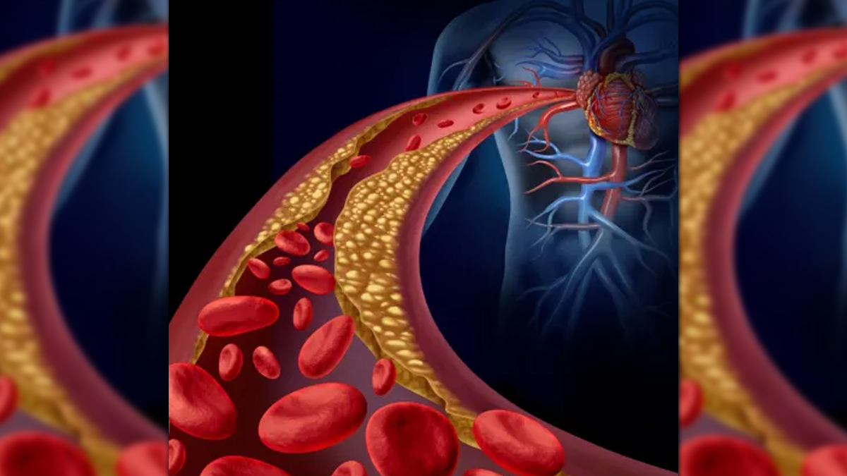 Atherosclerosis 2 - 2025-07-10T152341.186